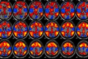 Estudo avalia relação entre padrões de sono e epilepsia