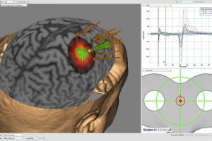 Unicamp adquire neuronavegador para cirurgias do cérebro