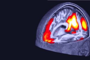 Alterações em rede neurofuncional fornecem pistas sobre Alzheimer