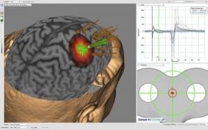 neuronavegador Unicamp