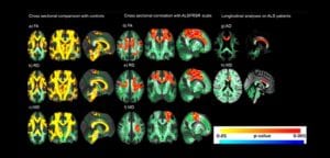 esclerose lateral amiotrofica - materia fapesp