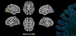 CEPID BRAINN - Divulgacao Agencia FAPESP - efeitos da covid-19 no cerebro
